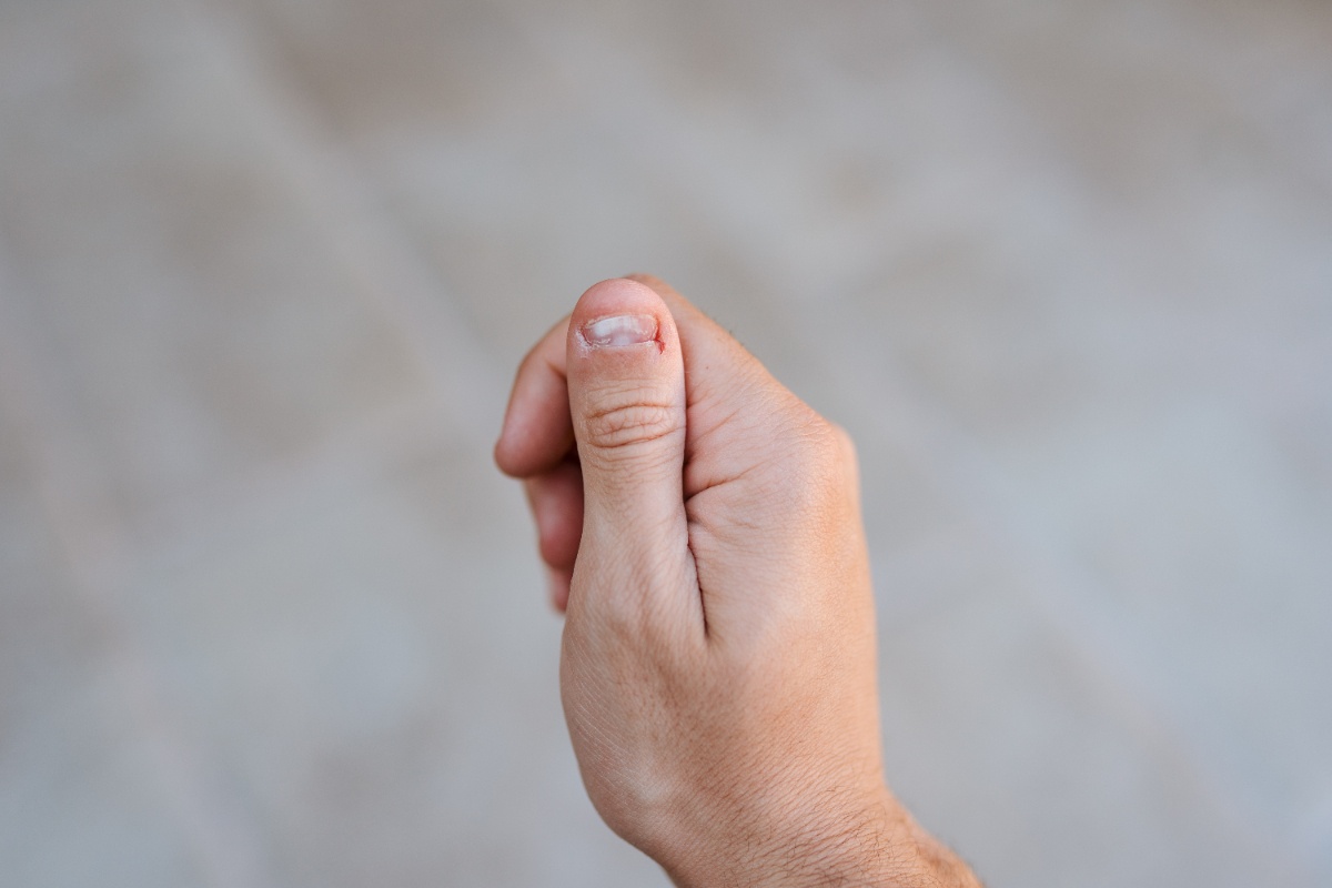 Main avec une infiltration sous l'ongle de la pouce