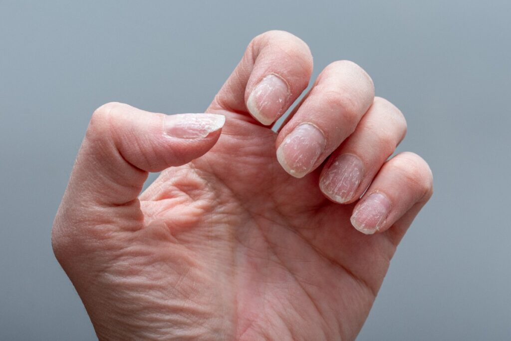 Main d'une personne avec des ongles cassés et fendus