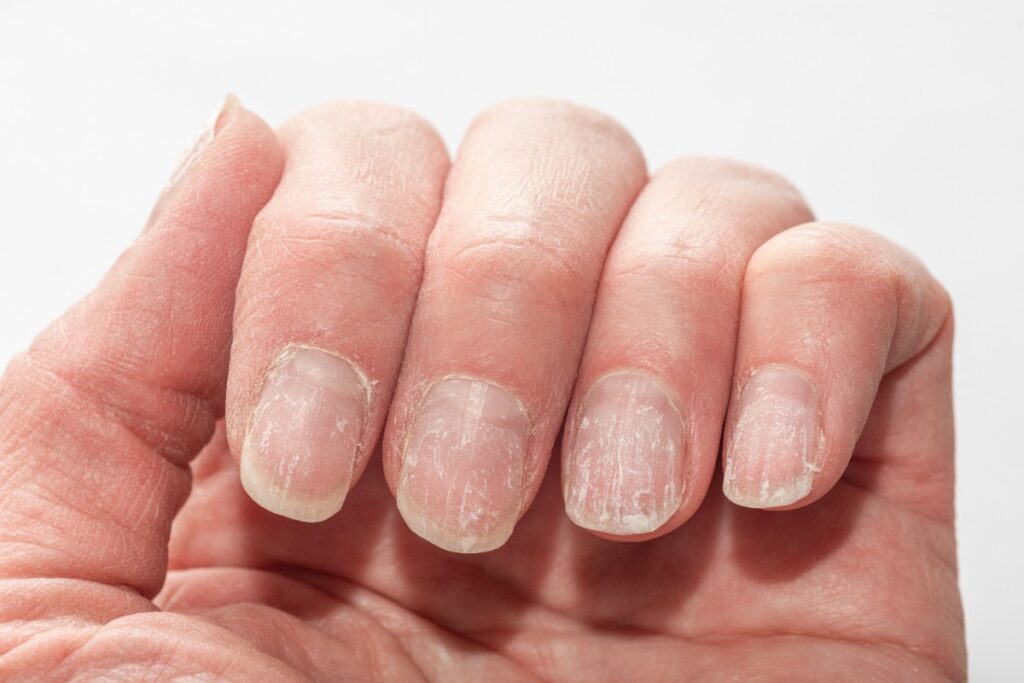 Une main avec des ongles jaunes et cassés