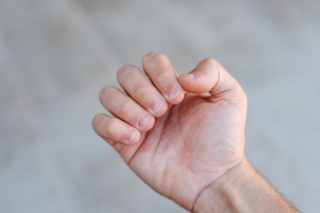 Main d'une personne avec ongle strié