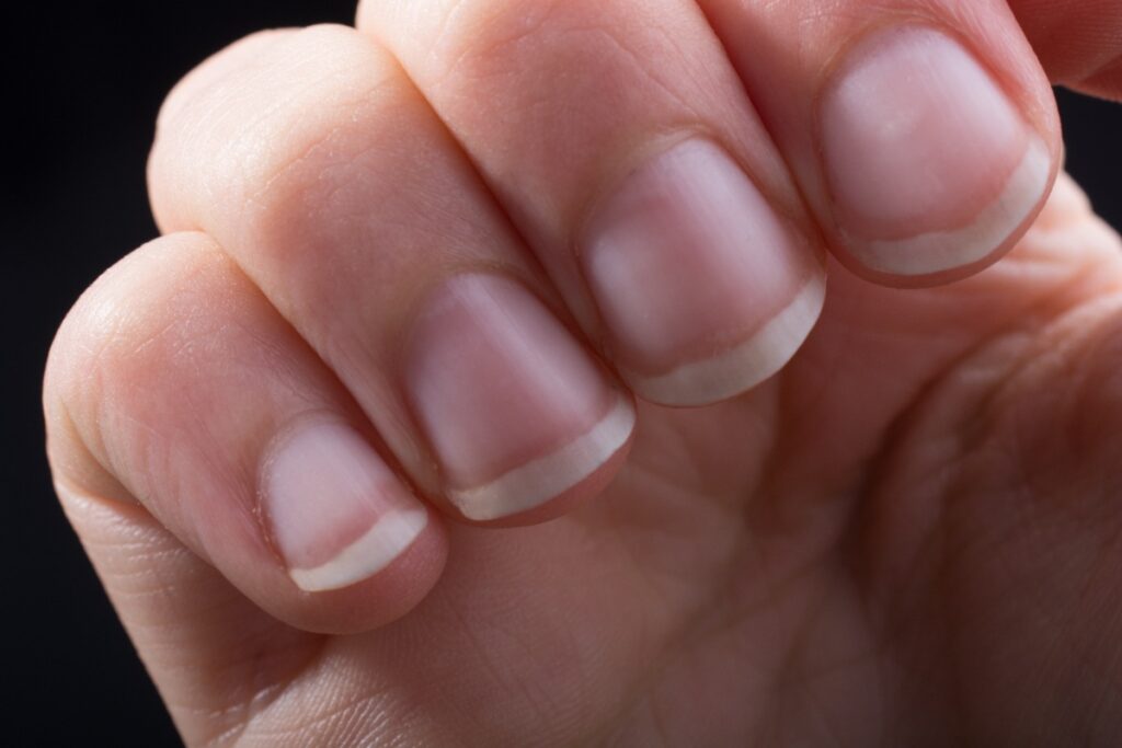 Une personne ayant des ongles striés