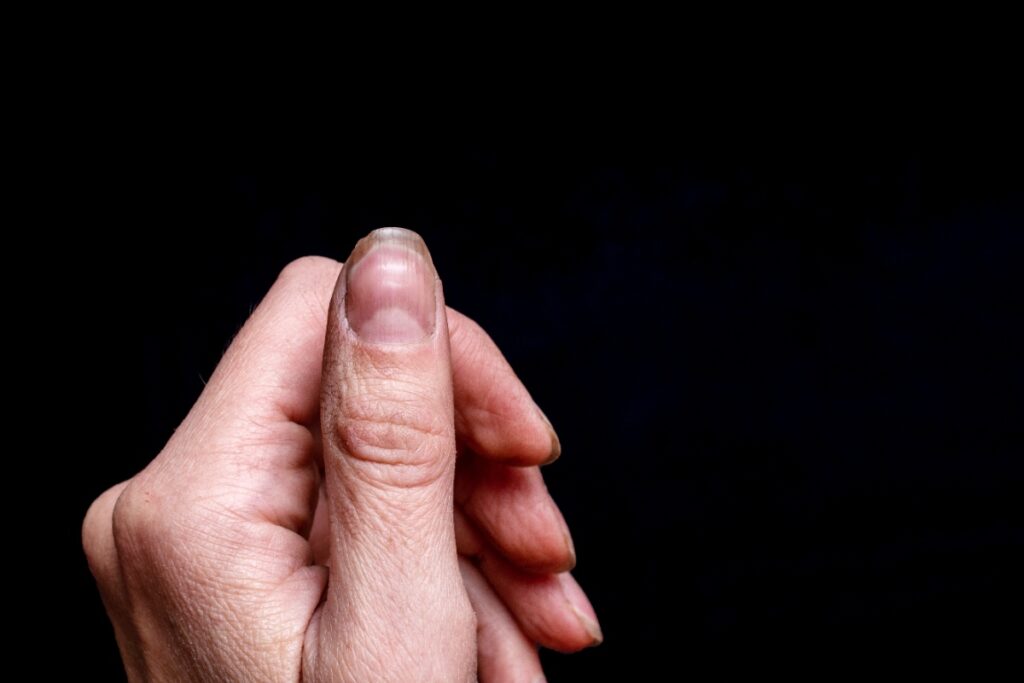 Main avec un ongle noir