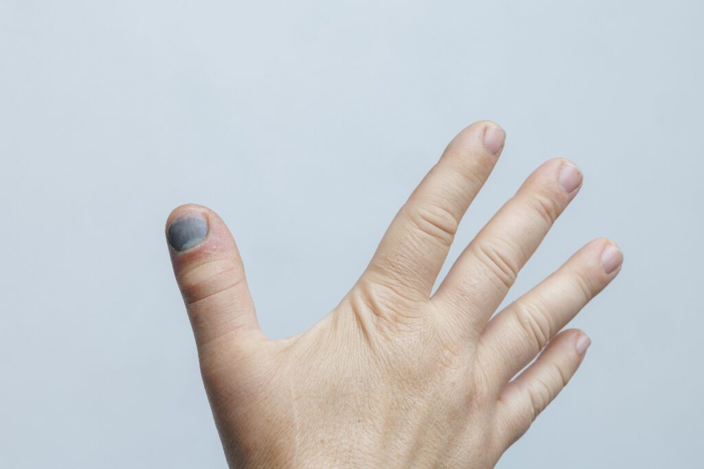 Ongle noir sur la pouce