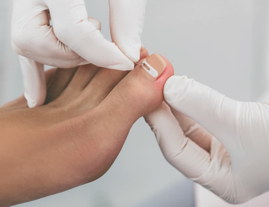 Soins des mycoses sur les ongles des pieds