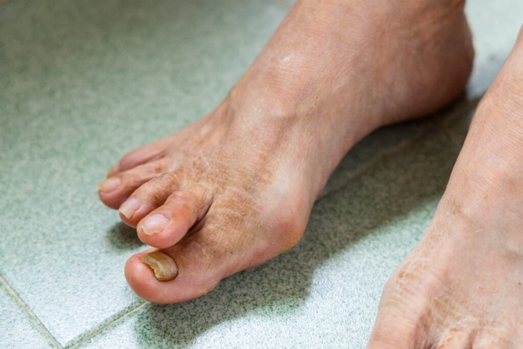 Symptômes des mycoses sur des ongles malades